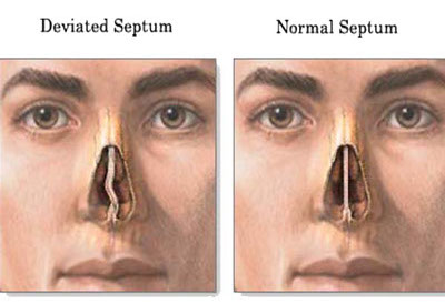 Deviated septum vs healthy septum